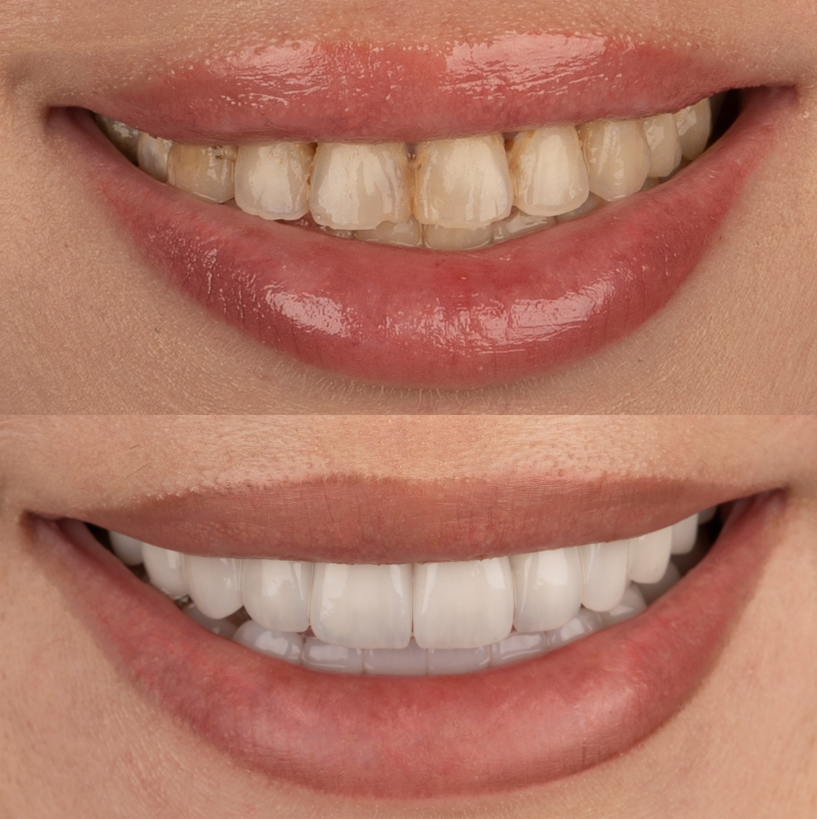 Patient smile transformation